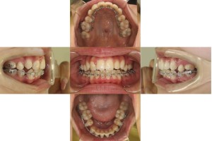 叢生・ハーフリンガルの症例