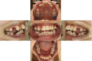 叢生・ハーフリンガルの症例