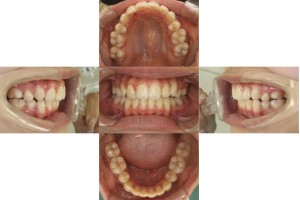 叢生・ハーフリンガルの症例