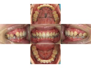 ハーフリンガルの症例