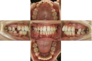 上顎前突・リンガル矯正の症例