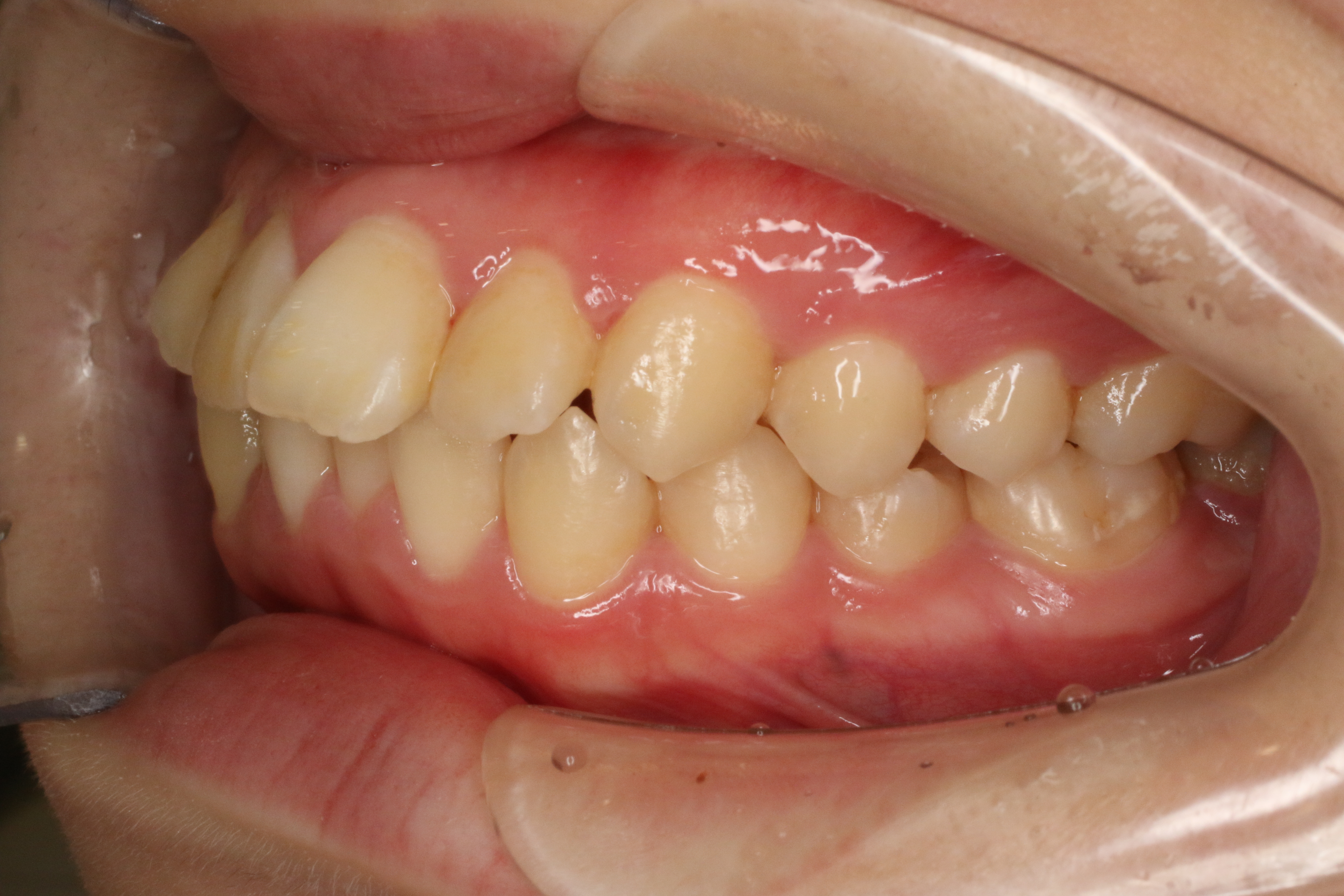 ハーフリンガルの症例