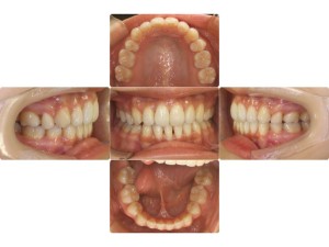 上顎前突・リンガル矯正の症例