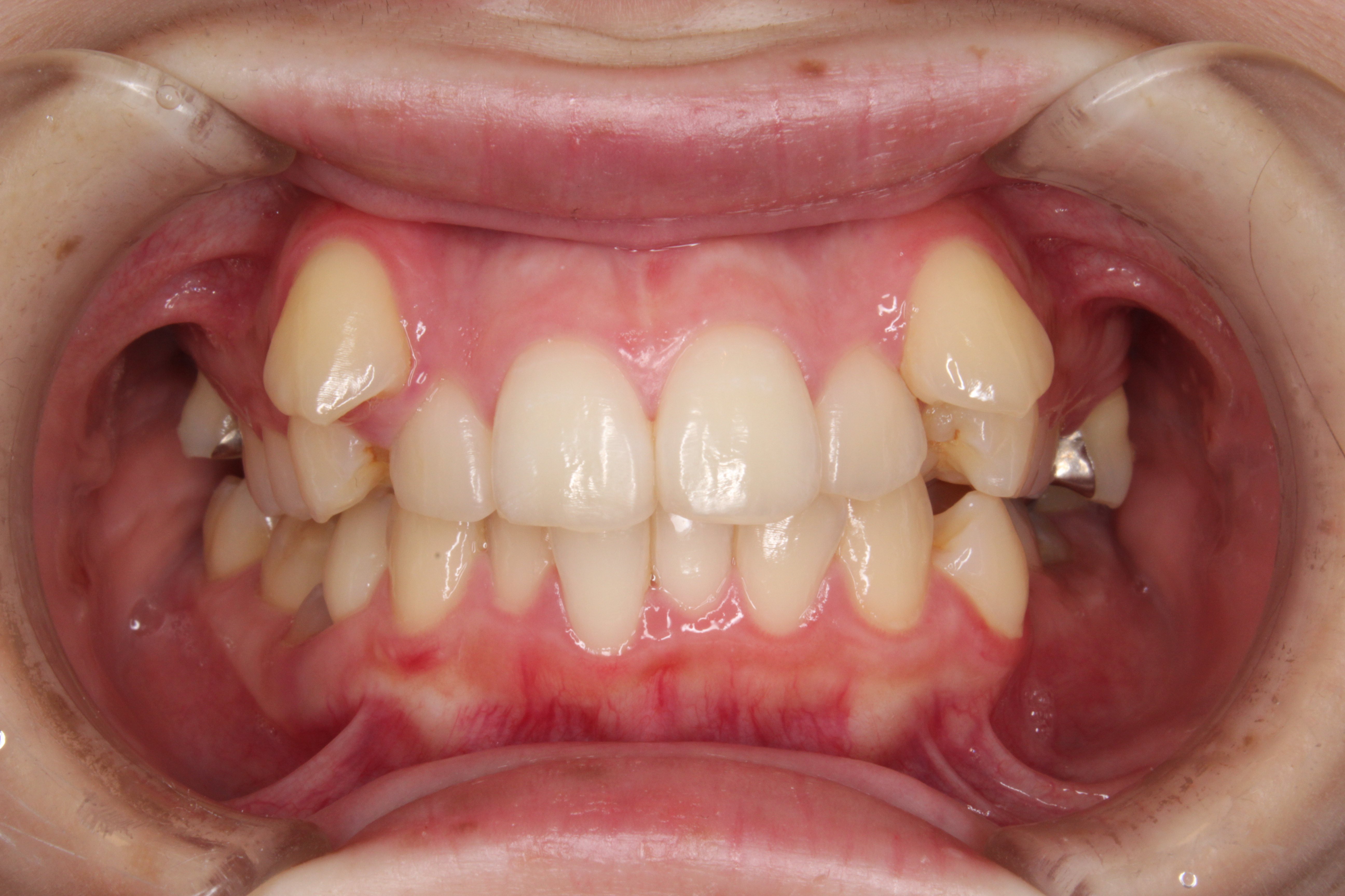 リンガル矯正の症例