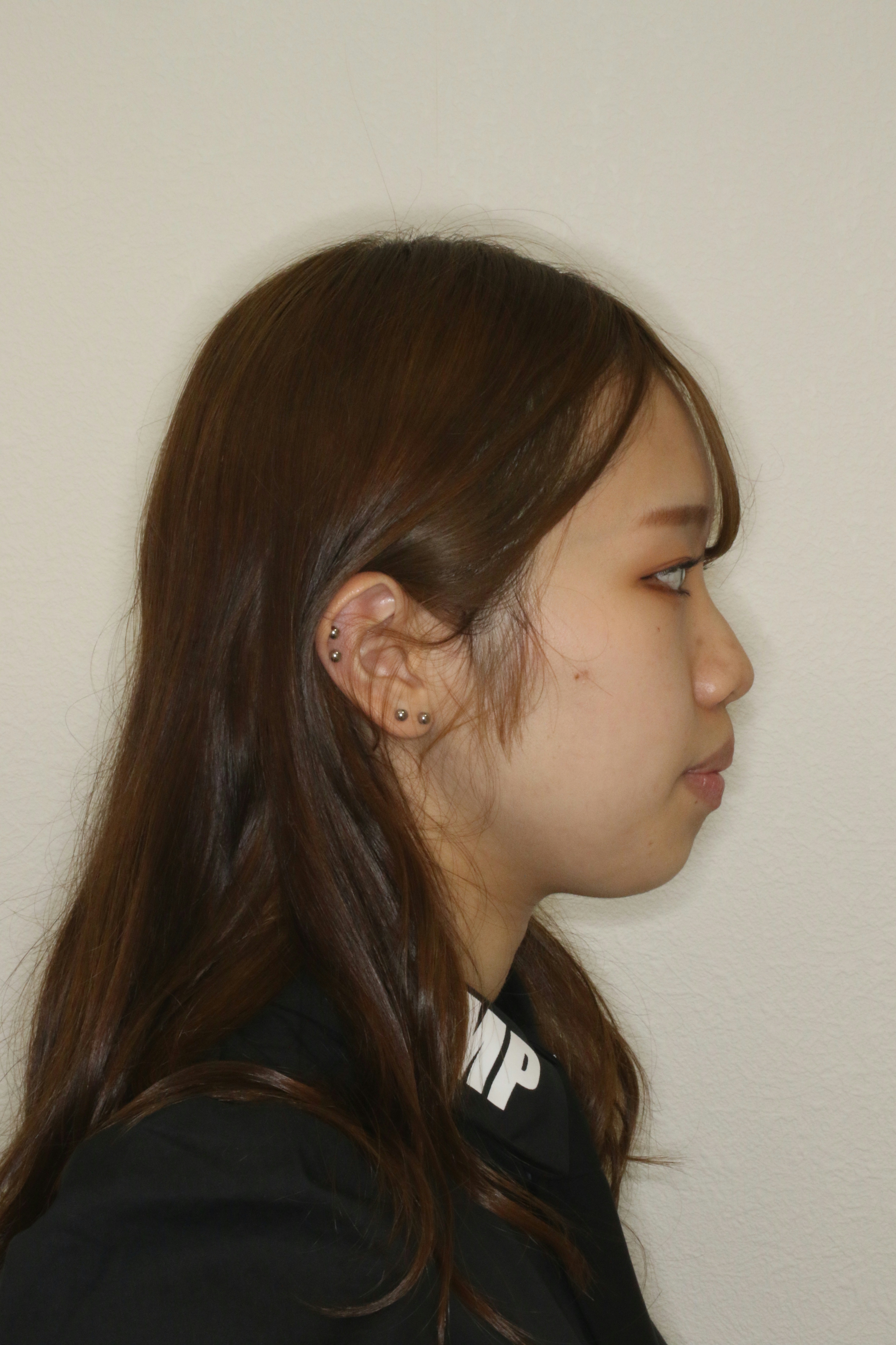 上顎前突・リンガル矯正の症例