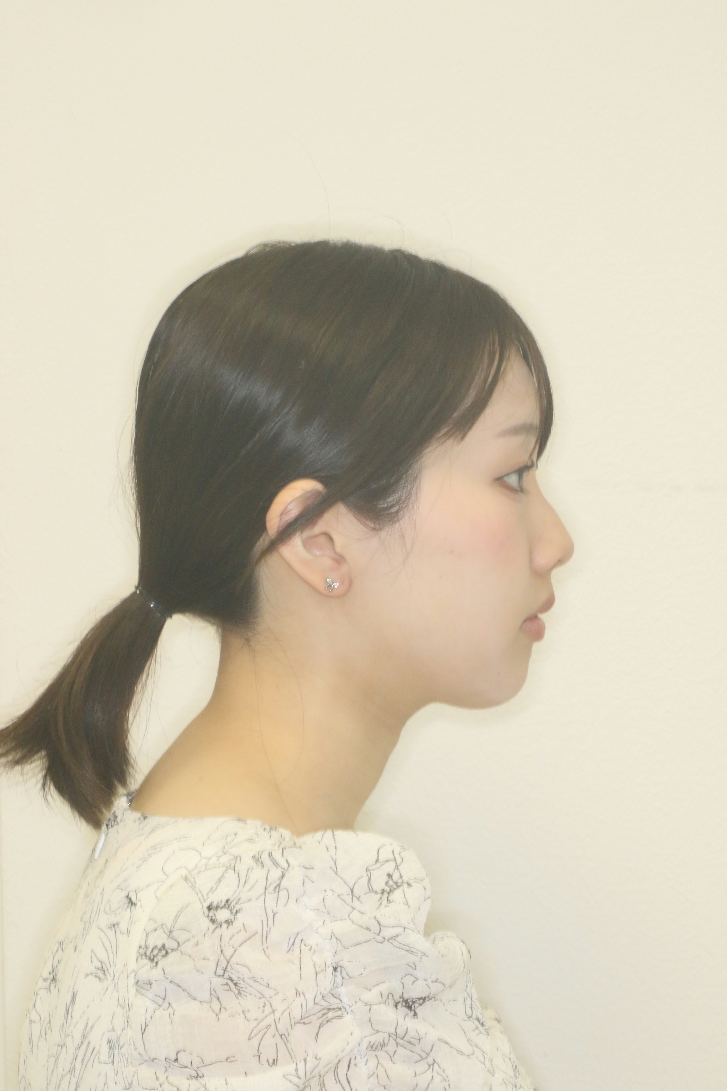 上顎前突・リンガル矯正の症例