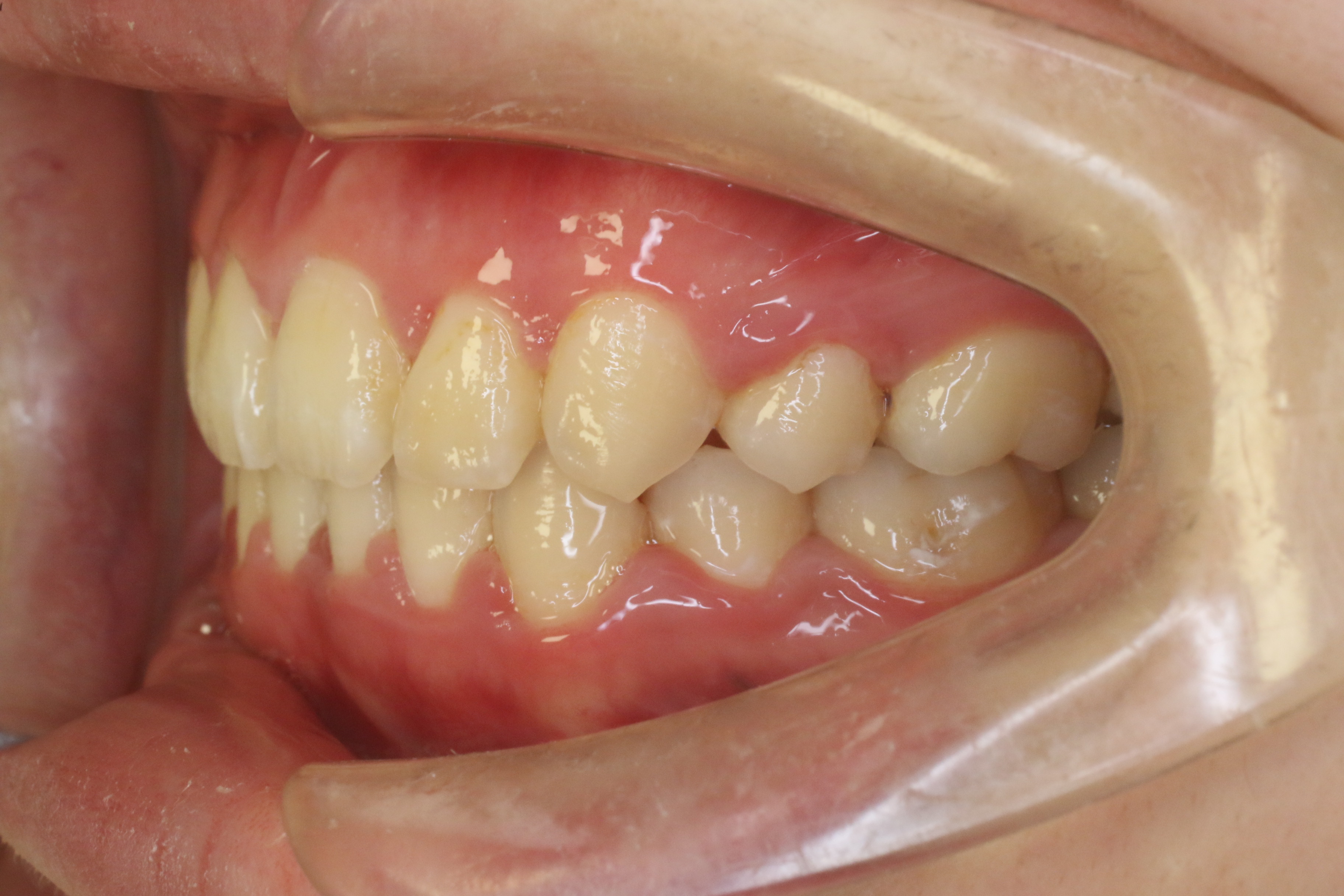 ハーフリンガルの症例