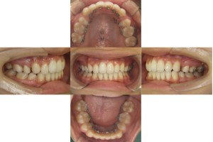 上顎前突・リンガル矯正の症例