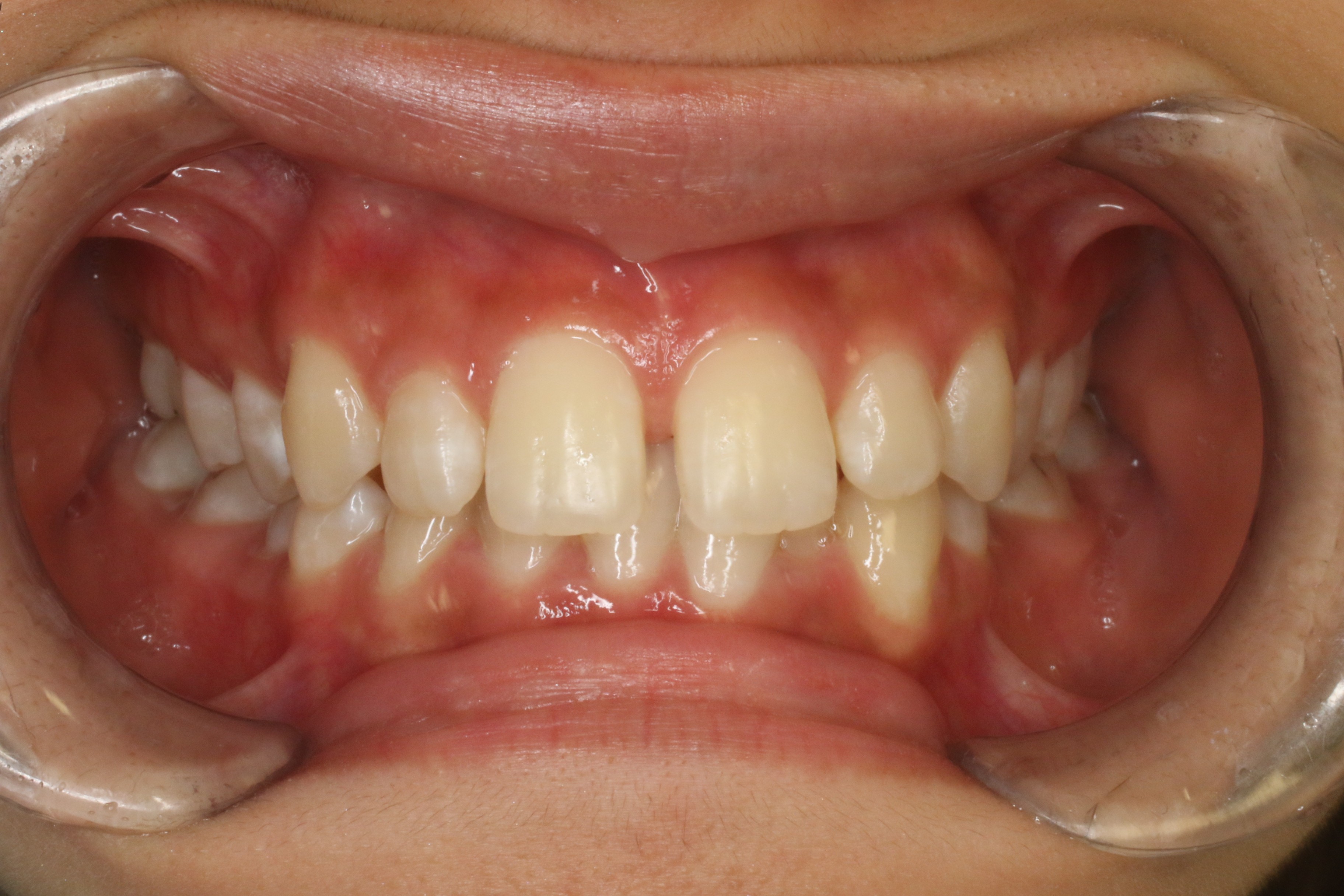 すきっぱ・部分リンガル矯正の症例