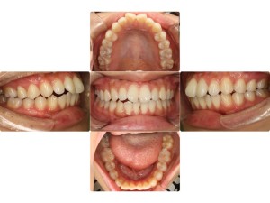 上顎前突・リンガル矯正の症例