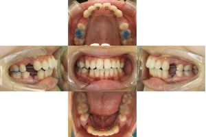 上顎前突・リンガル矯正の症例