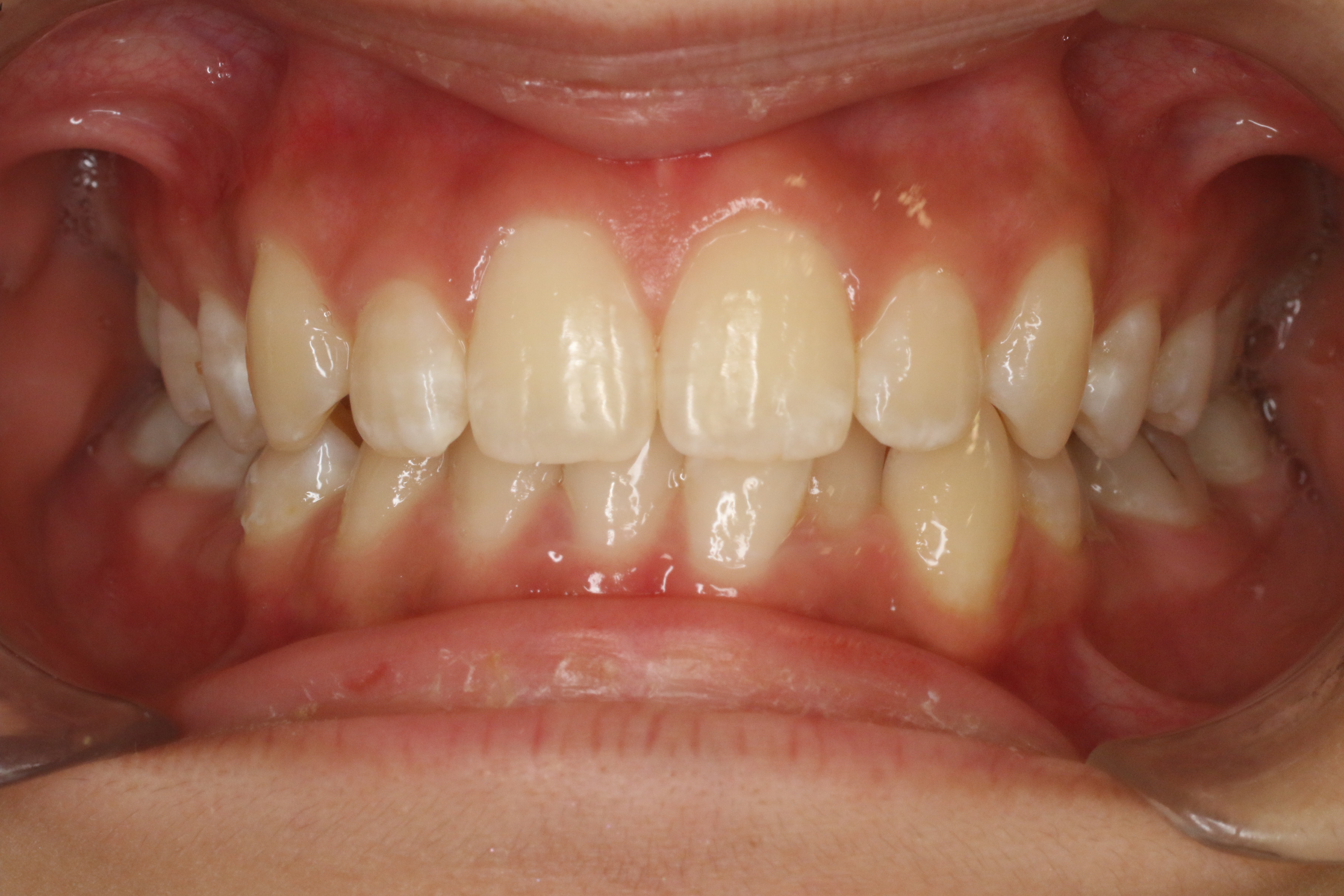 すきっぱ・部分リンガル矯正の症例