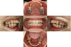 リンガル矯正の症例