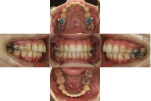 八重歯・リンガル矯正の症例