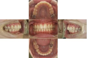 八重歯・リンガル矯正の症例