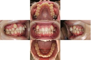 リンガル矯正の症例