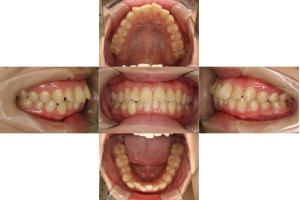 ハーフリンガルの症例