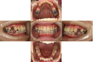 ハーフリンガルの症例