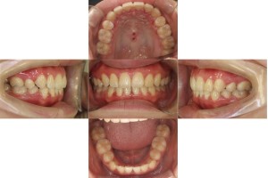 ハーフリンガルの症例