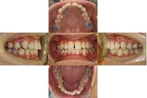 すきっぱ・部分リンガル矯正の症例