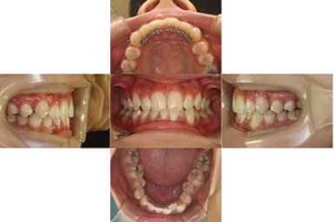 すきっぱ・部分リンガル矯正の症例