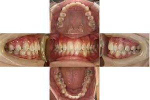 すきっぱ・部分リンガル矯正の症例