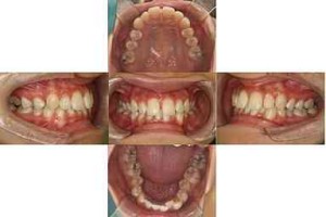 すきっぱ・部分リンガル矯正の症例