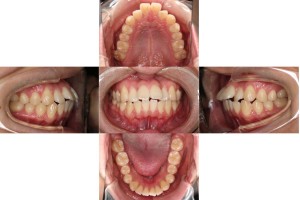 リンガルの症例