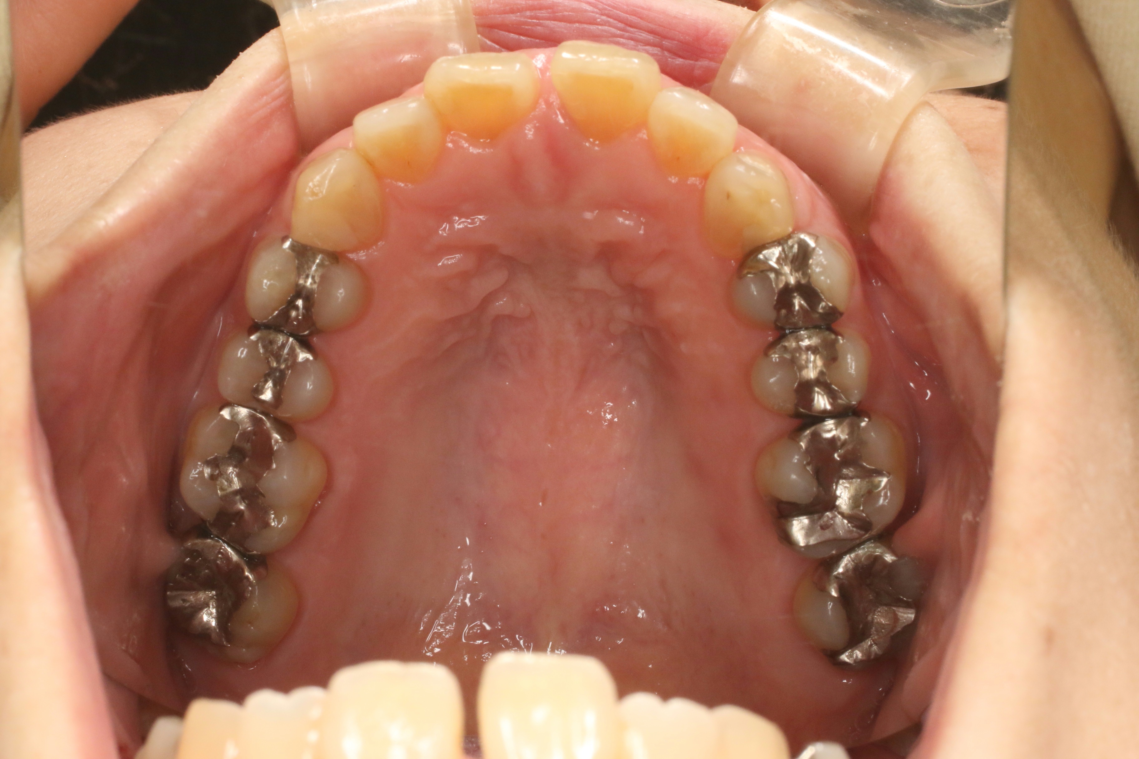 すきっぱ/表側矯正の症例