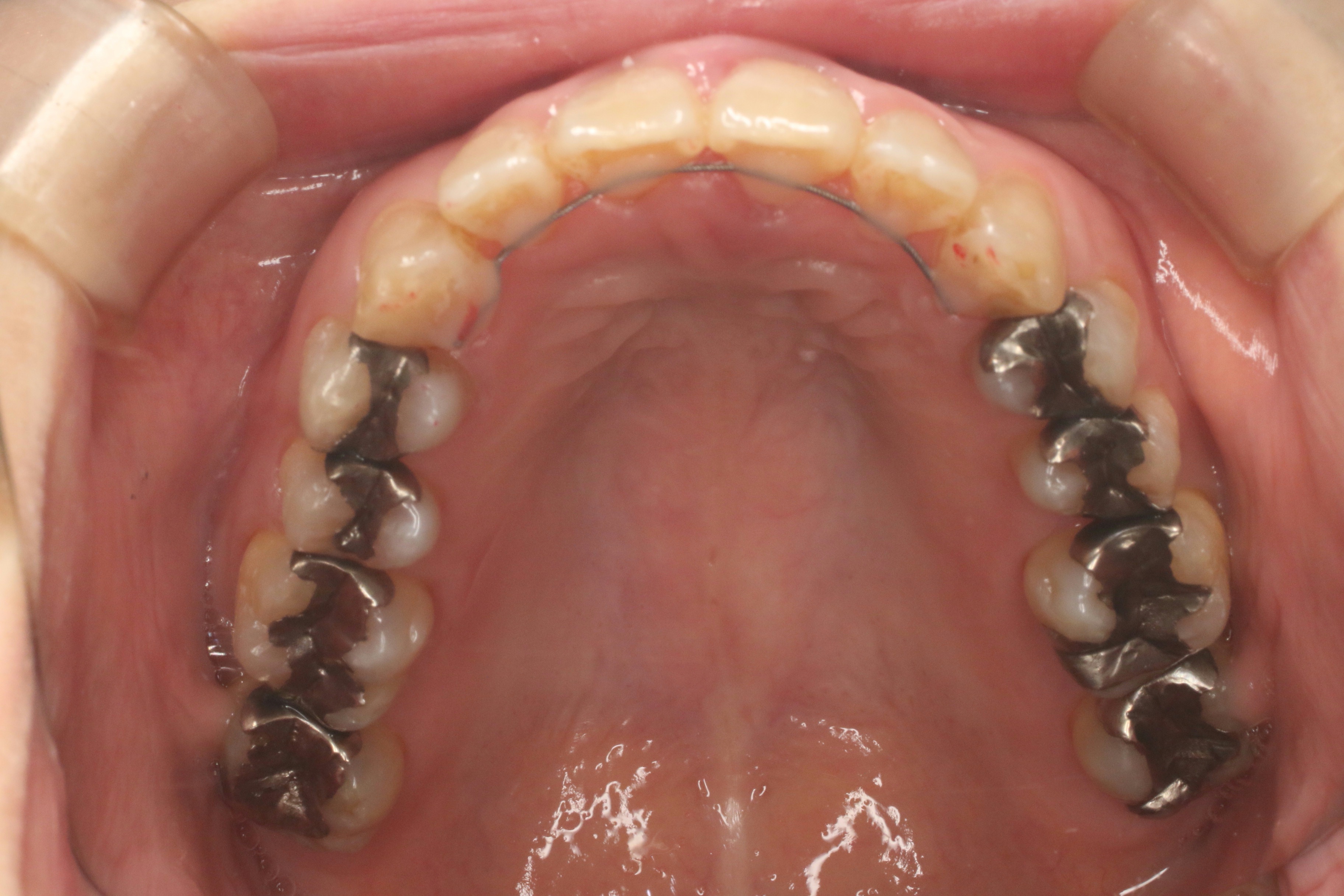 すきっぱ/表側矯正の症例