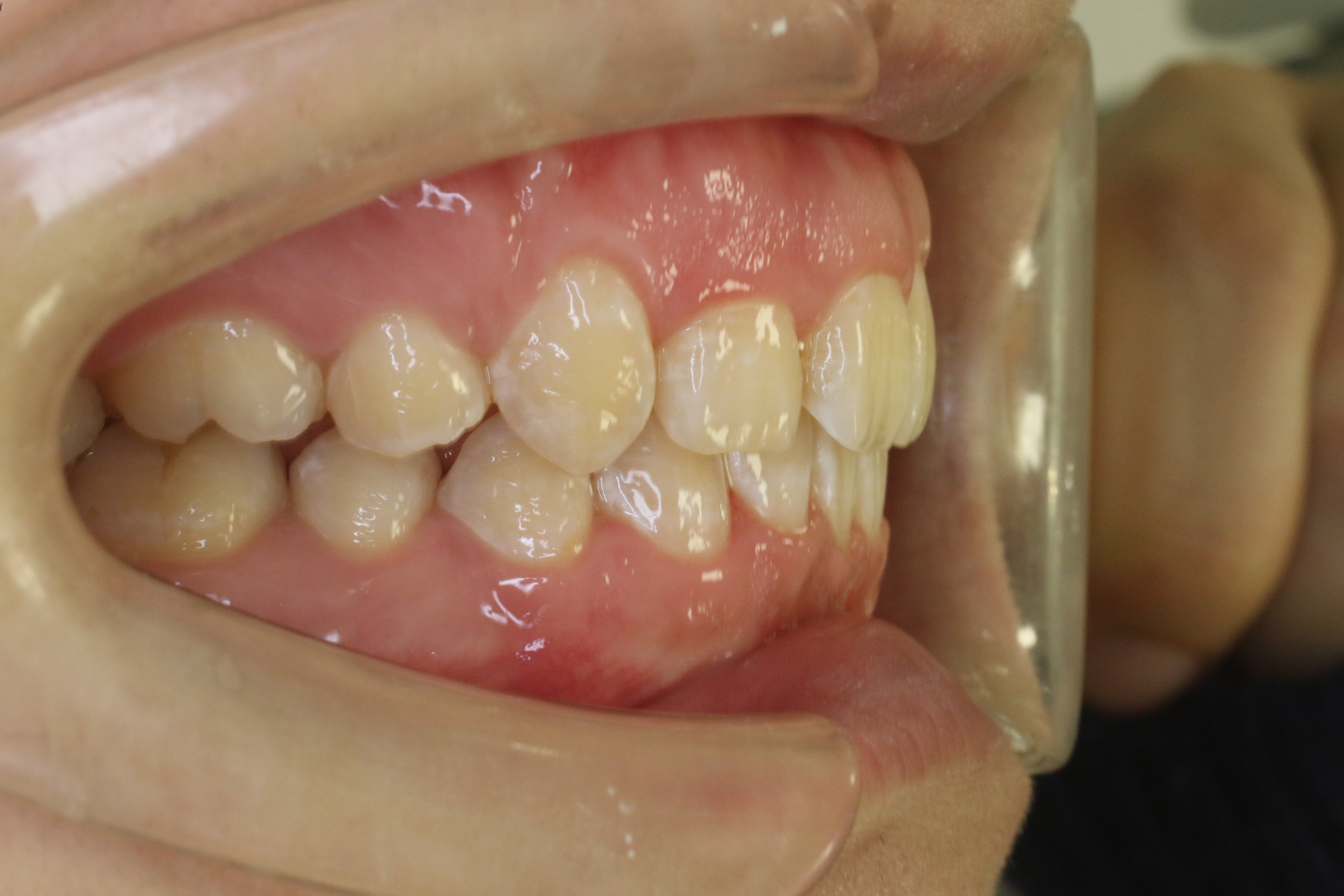 すきっぱ・八重歯/リンガル矯正の症例