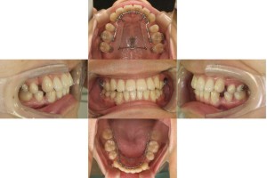 リンガルの症例