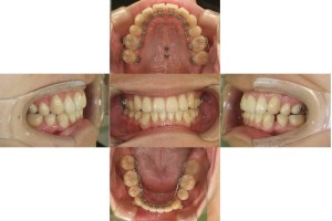 リンガルの症例