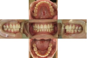 リンガルの症例