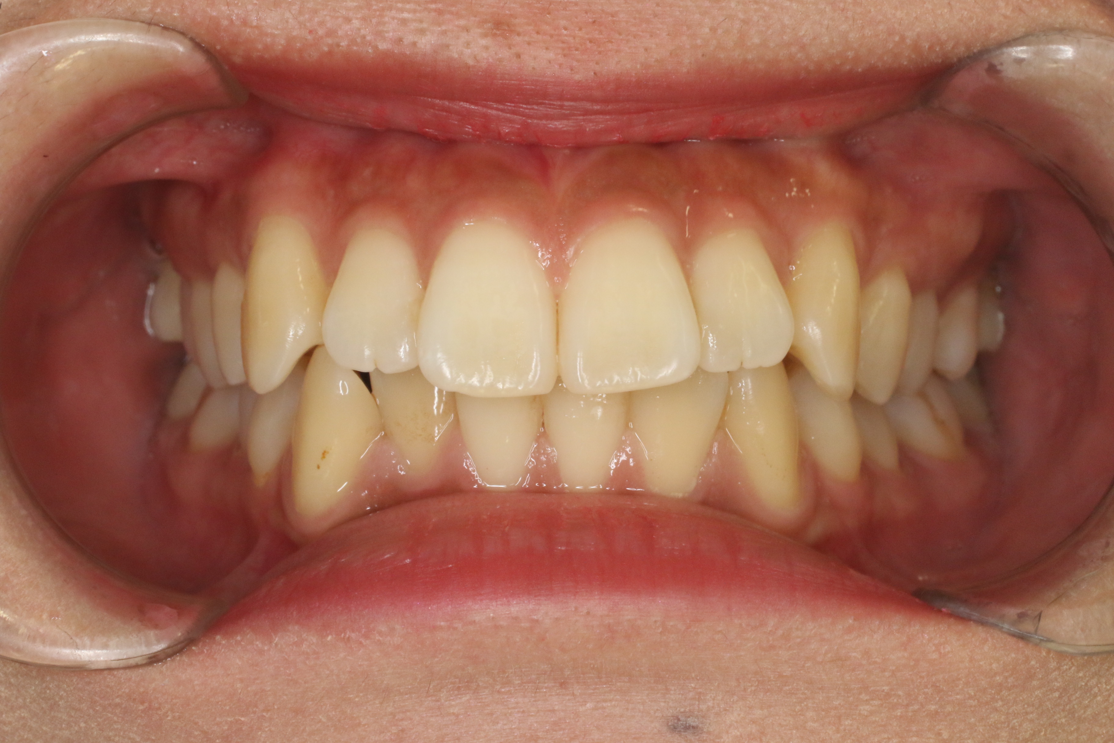 出っ歯・がたつき/リンガル矯正の症例