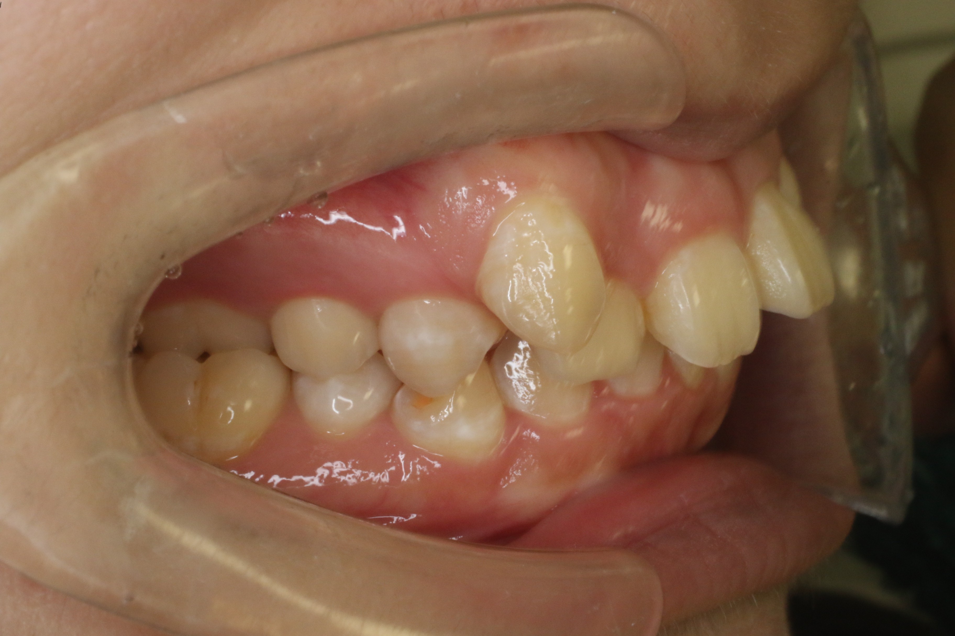 すきっぱ・八重歯・リンガル矯正の症例