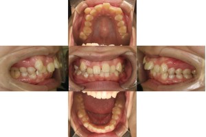 すきっぱ・八重歯/リンガル矯正の症例