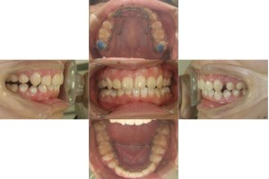 すきっぱ・八重歯/リンガル矯正の症例