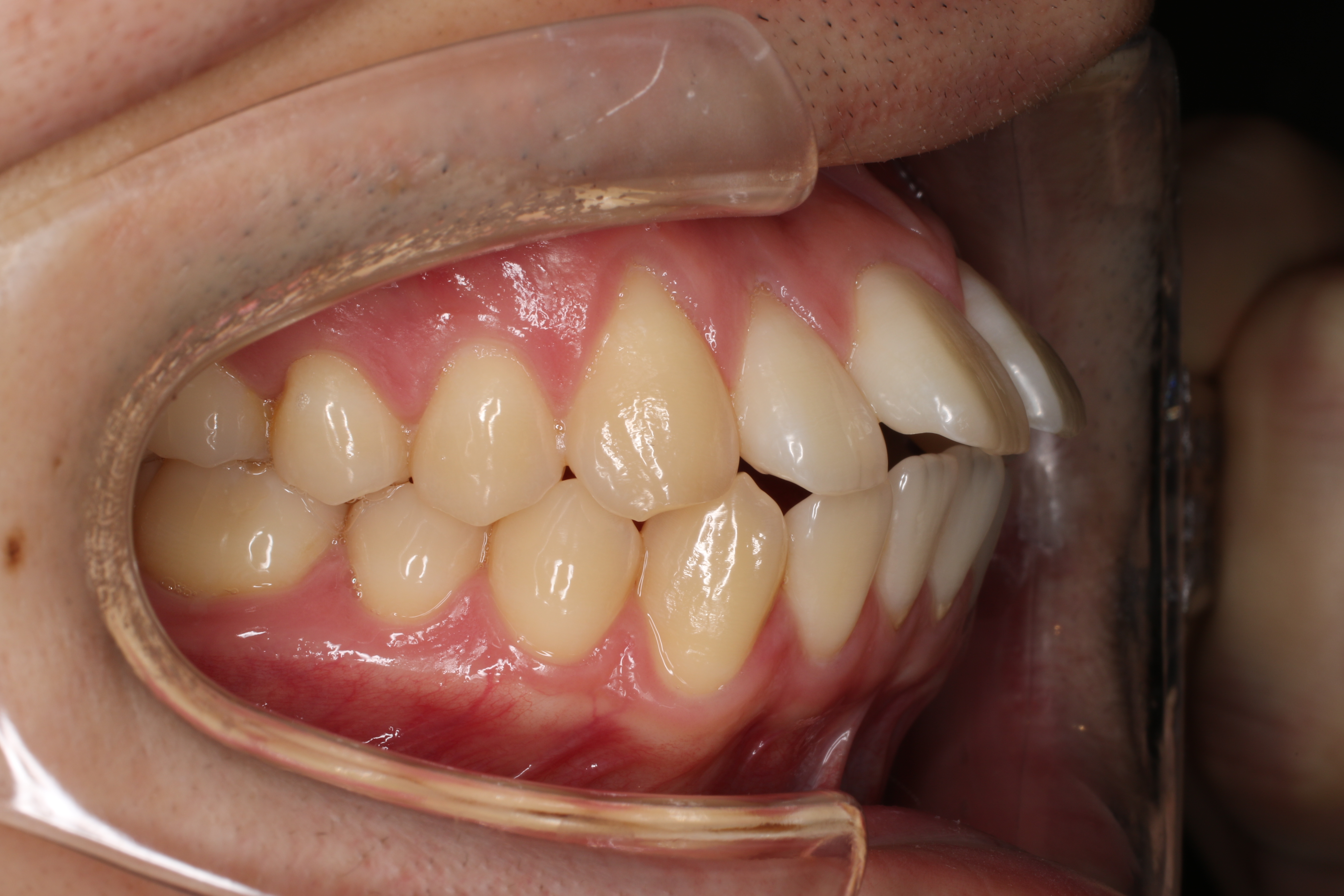 リンガル矯正の症例