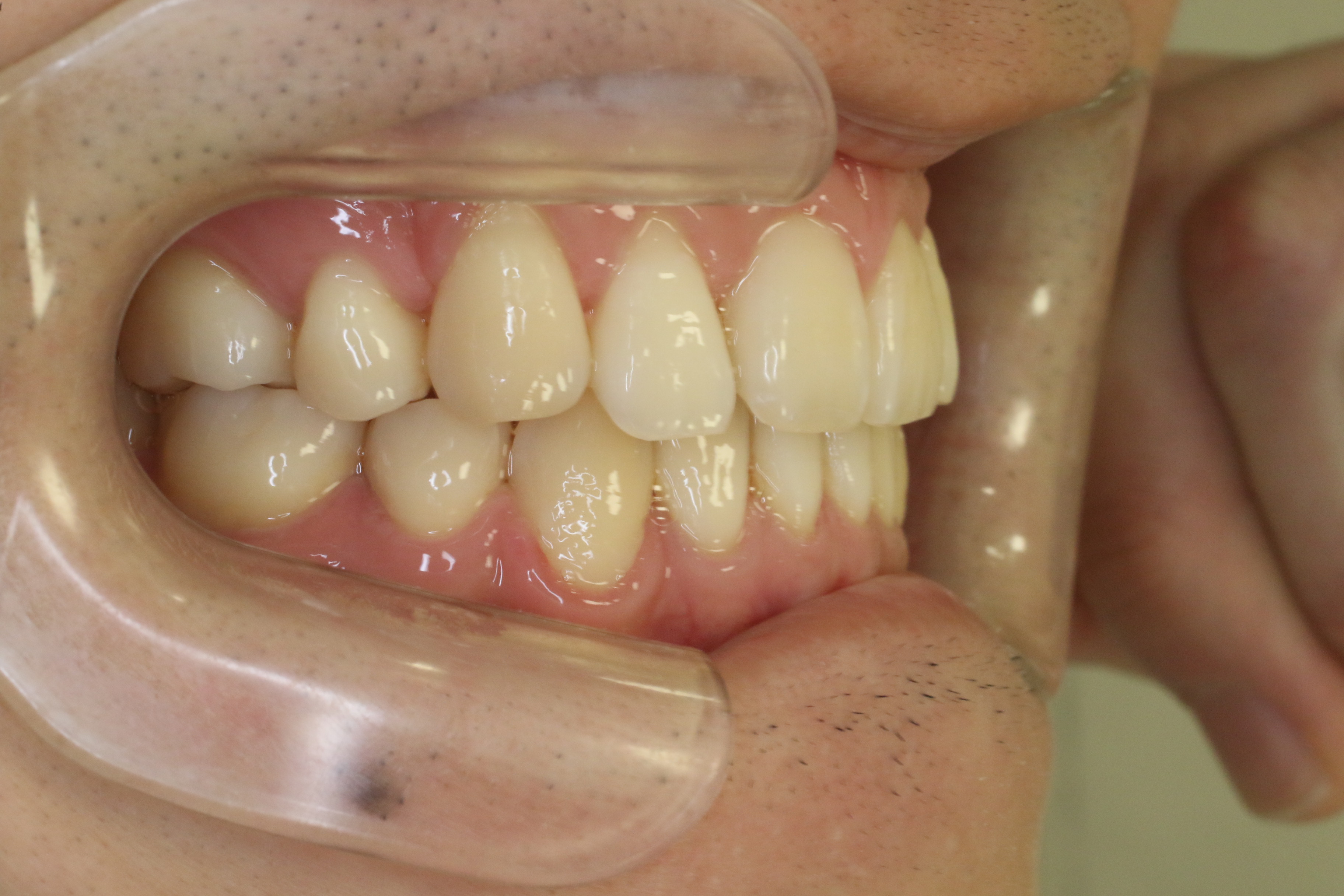 リンガル矯正の症例