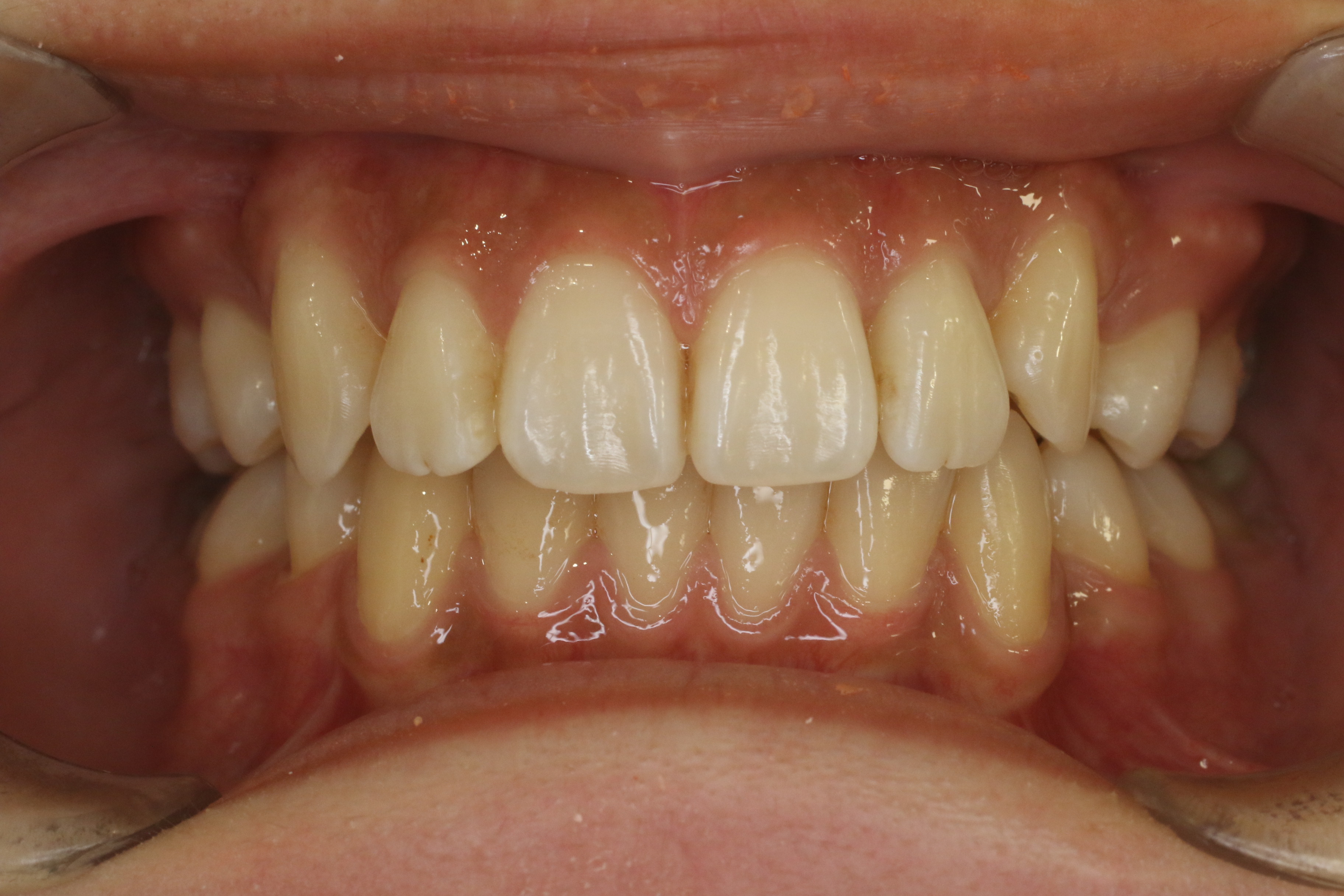 出っ歯・がたつき/リンガル矯正の症例