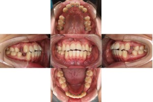 リンガルの症例