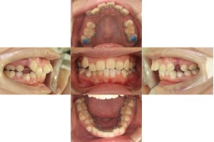 すきっぱ・八重歯/リンガル矯正の症例