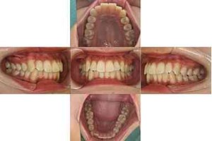 出っ歯・がたつき/リンガル矯正の症例