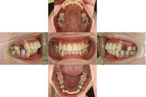 出っ歯・がたつき/リンガル矯正の症例