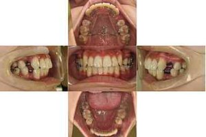 出っ歯/がたつき/リンガル矯正の症例