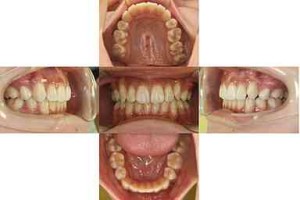 出っ歯・がたつき/リンガル矯正の症例