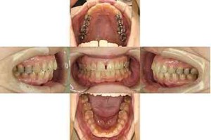 すきっぱ/表側矯正の症例