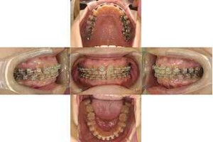 すきっぱ/表側矯正の症例