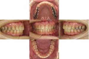 すきっぱ/表側矯正の症例